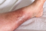 Understanding the Signs of Deep Vein Thrombosis |